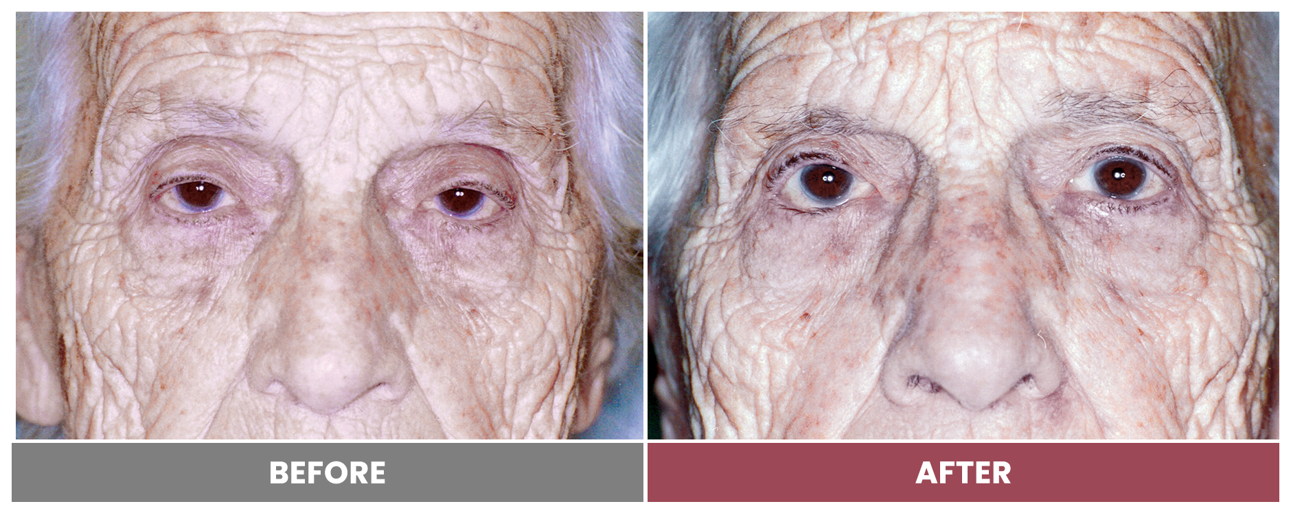 PTOSIS REPAIR - Case 8